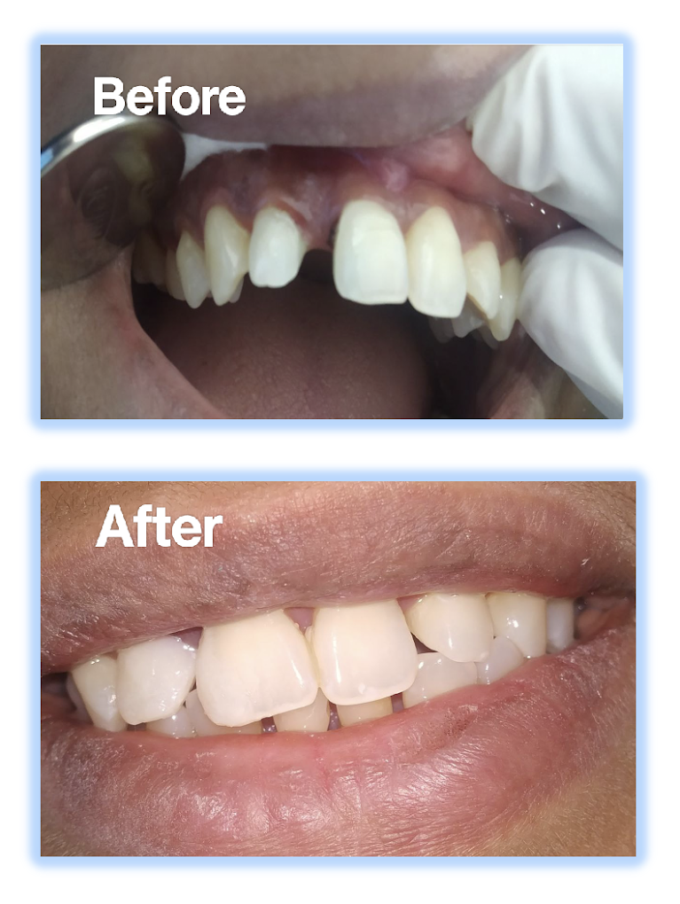 Teeth Whitening